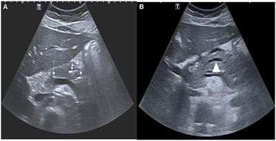 Acute Pancreatitis in Jordanian Children: A Single Center Experience